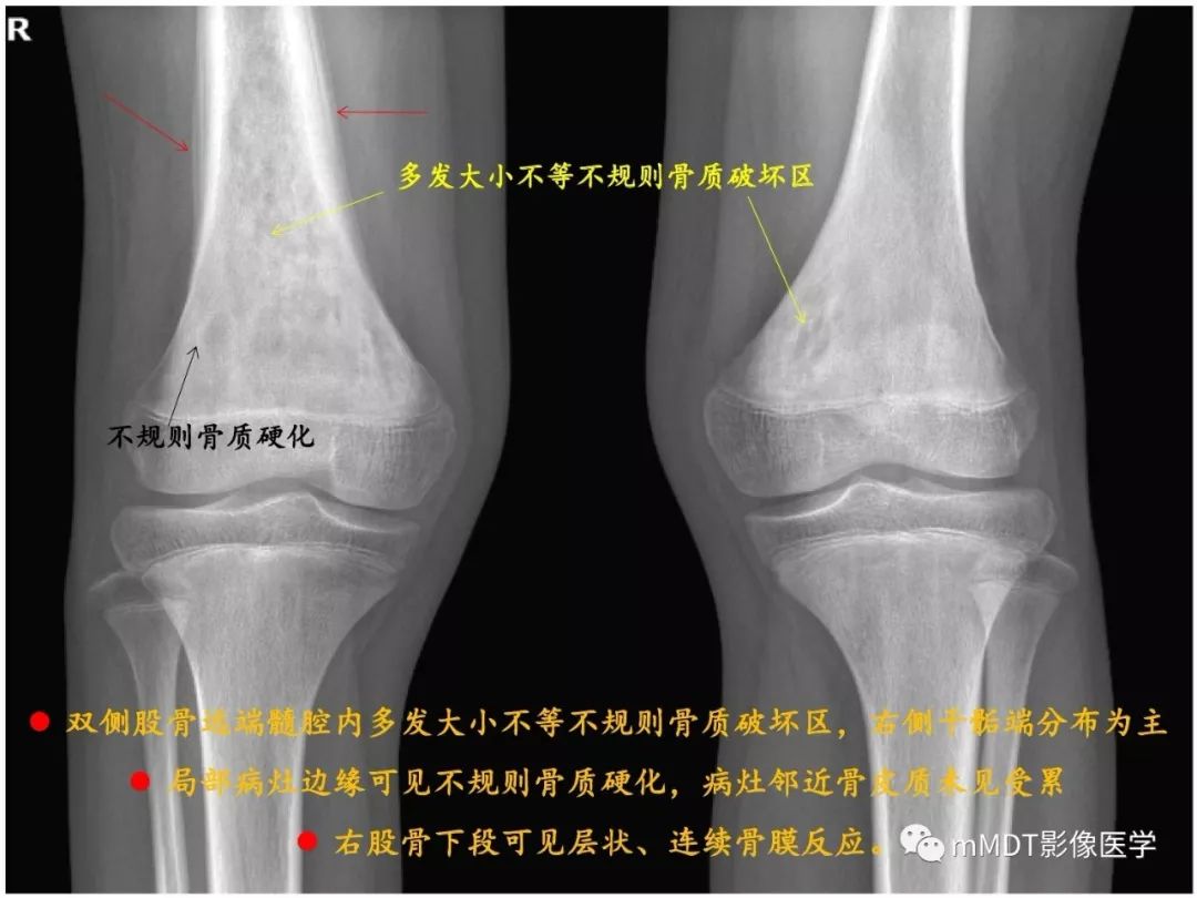 【PPT】多灶性骨病影像分析思路(不常见感染篇)
