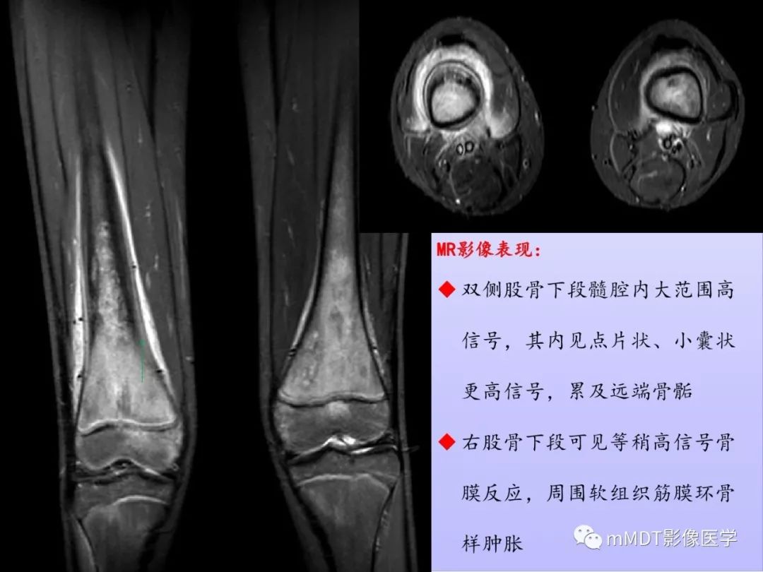【PPT】多灶性骨病影像分析思路(不常见感染篇)