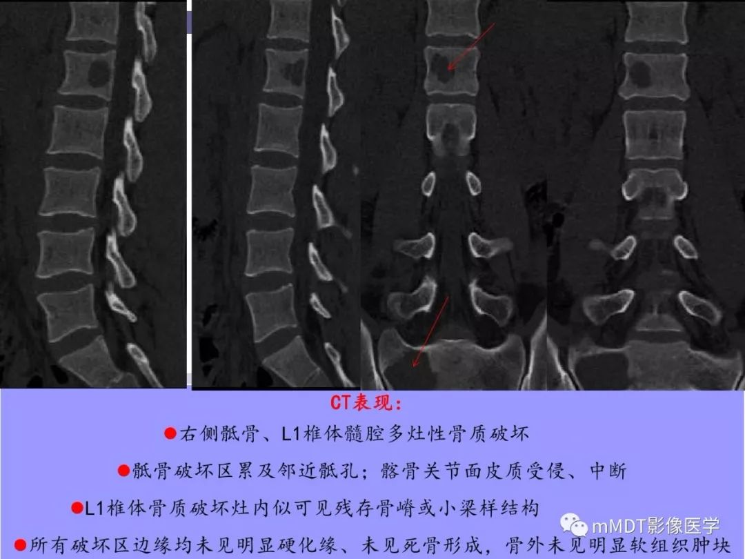 【PPT】多灶性骨病影像分析思路(不常见感染篇)