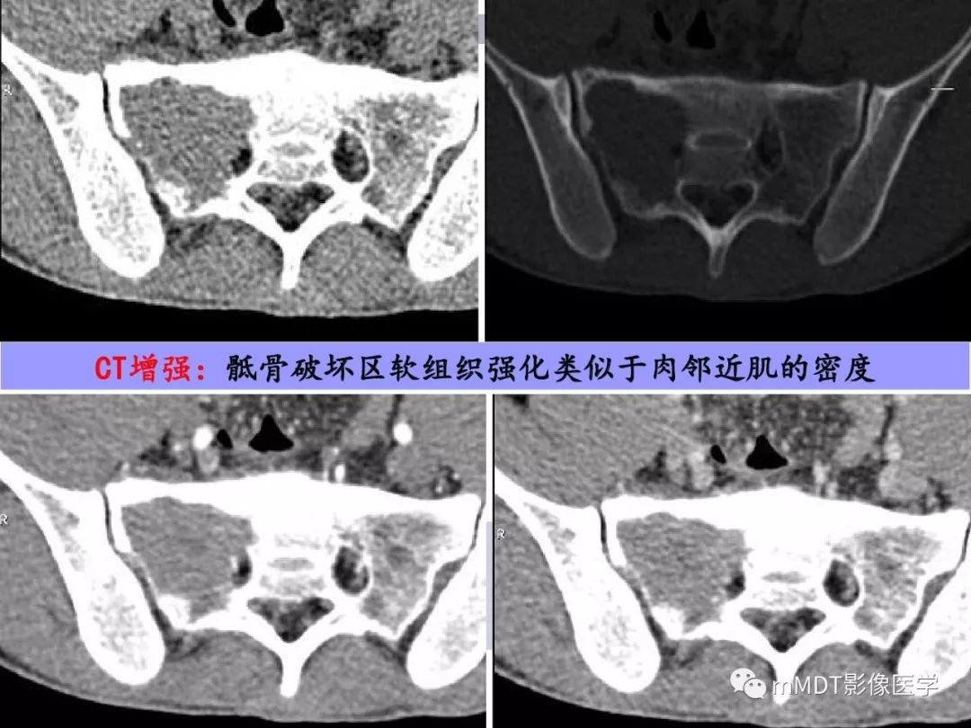 【PPT】多灶性骨病影像分析思路(不常见感染篇)
