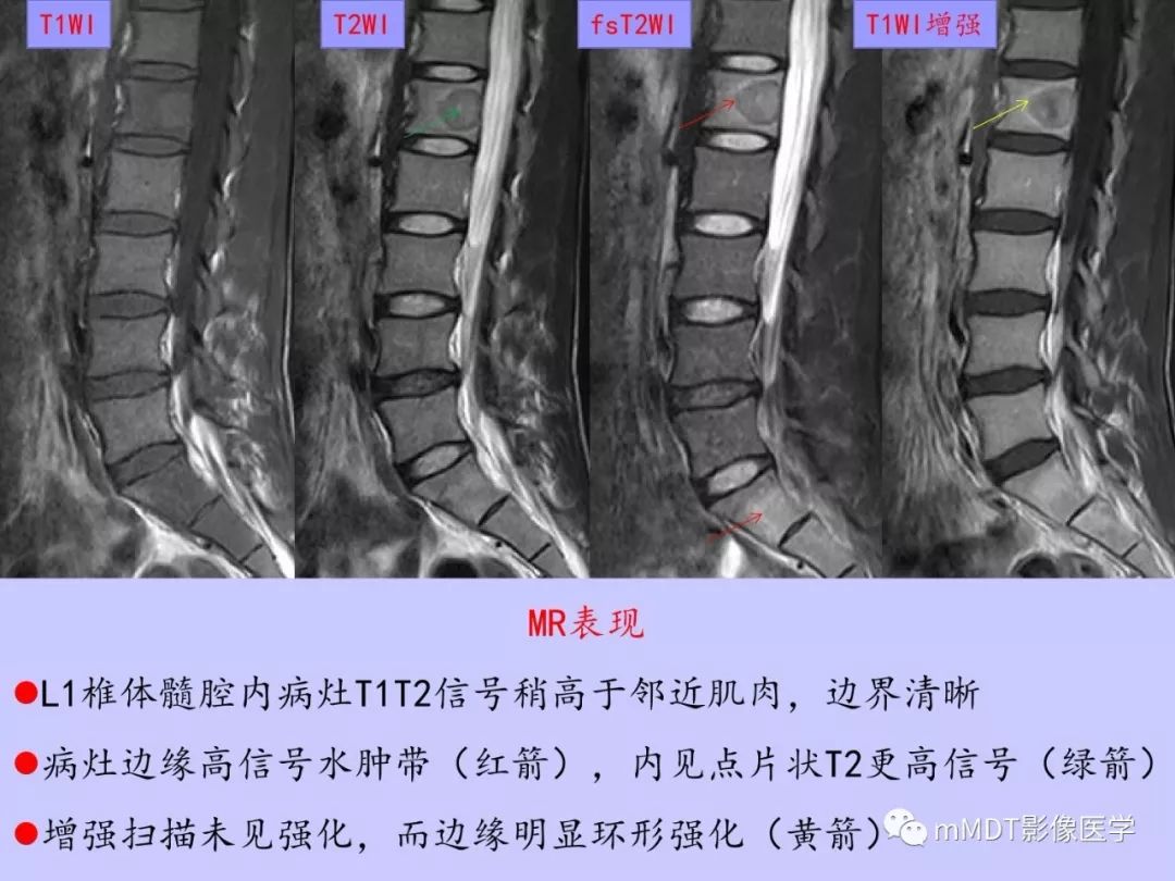 【PPT】多灶性骨病影像分析思路(不常见感染篇)