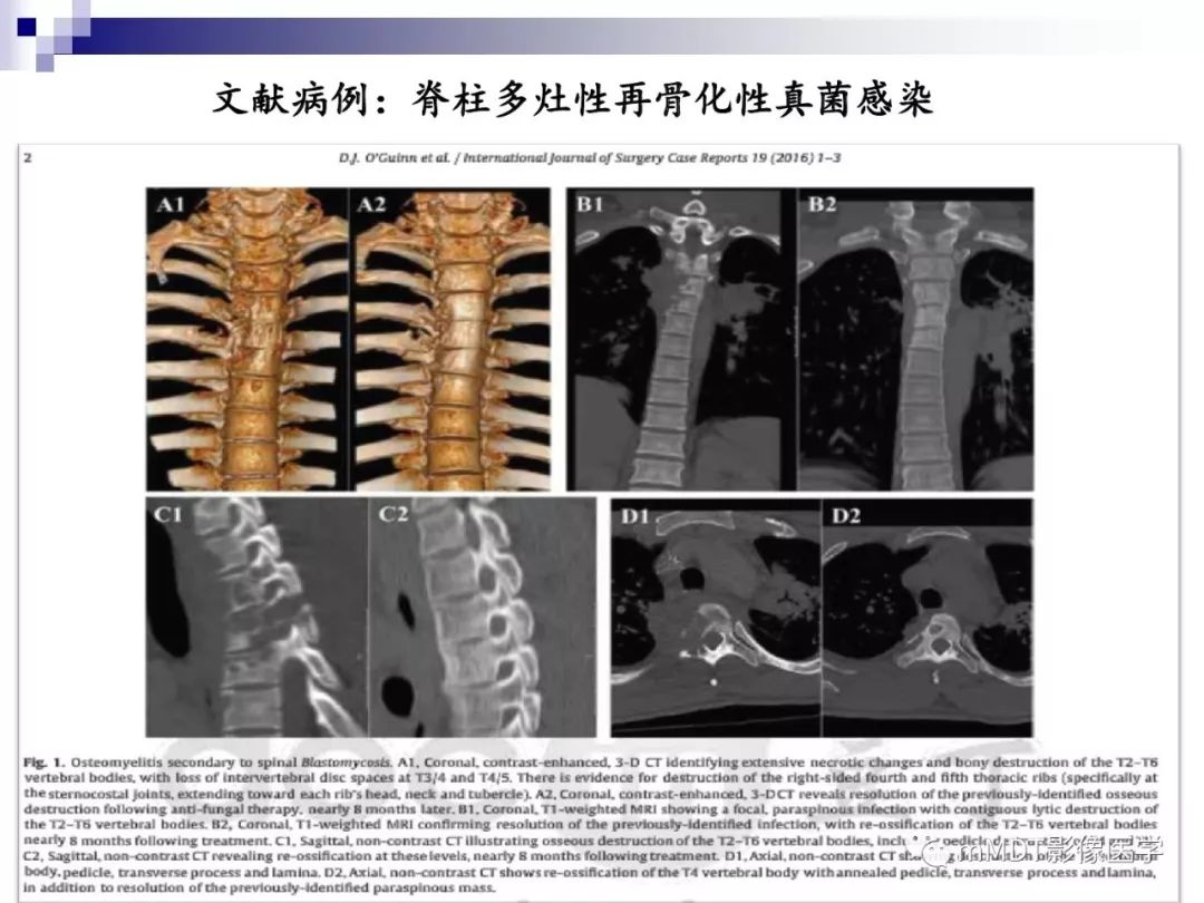 【PPT】多灶性骨病影像分析思路(不常见感染篇)