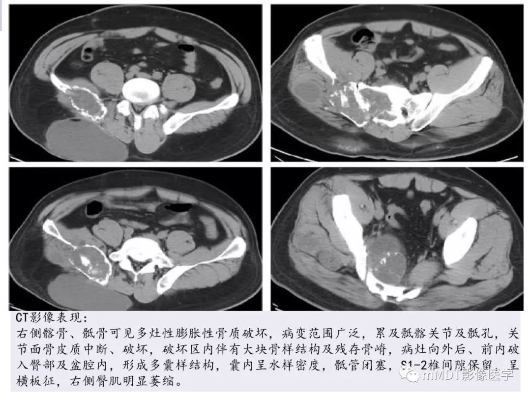 【PPT】多灶性骨病影像分析思路(不常见感染篇)