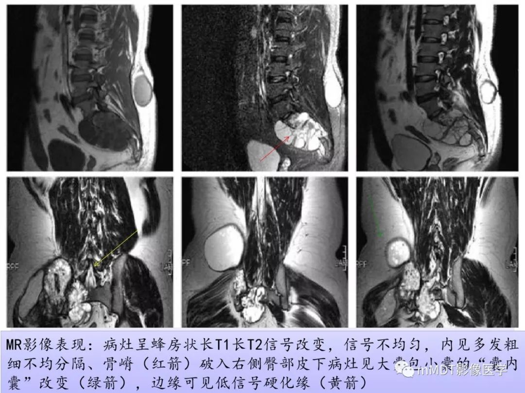 【PPT】多灶性骨病影像分析思路(不常见感染篇)