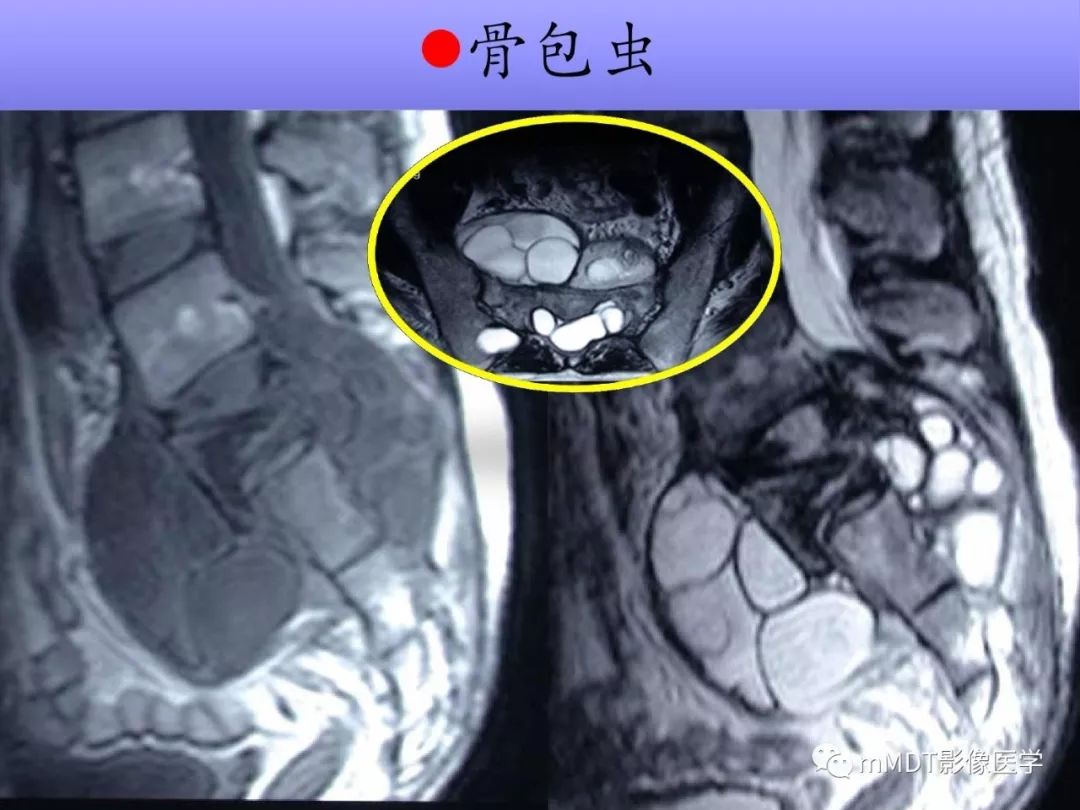 【PPT】多灶性骨病影像分析思路(不常见感染篇)