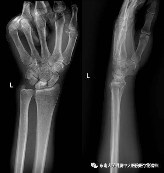 【病例】腕月骨无菌性坏死1例X线MR影像诊断