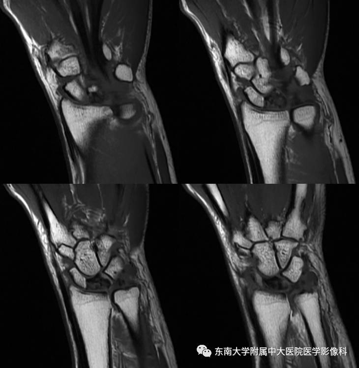 【病例】腕月骨无菌性坏死1例X线MR影像诊断