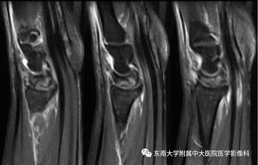 【病例】腕月骨无菌性坏死1例X线MR影像诊断