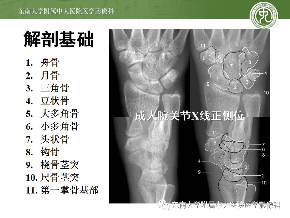 【病例】腕月骨无菌性坏死1例X线MR影像诊断