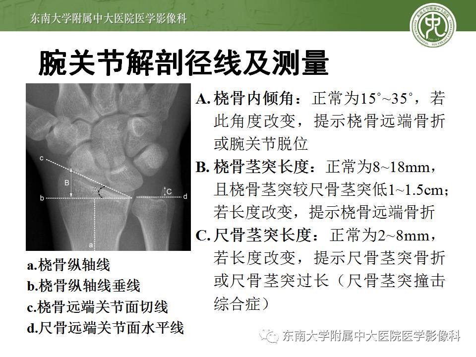 【病例】腕月骨无菌性坏死1例X线MR影像诊断