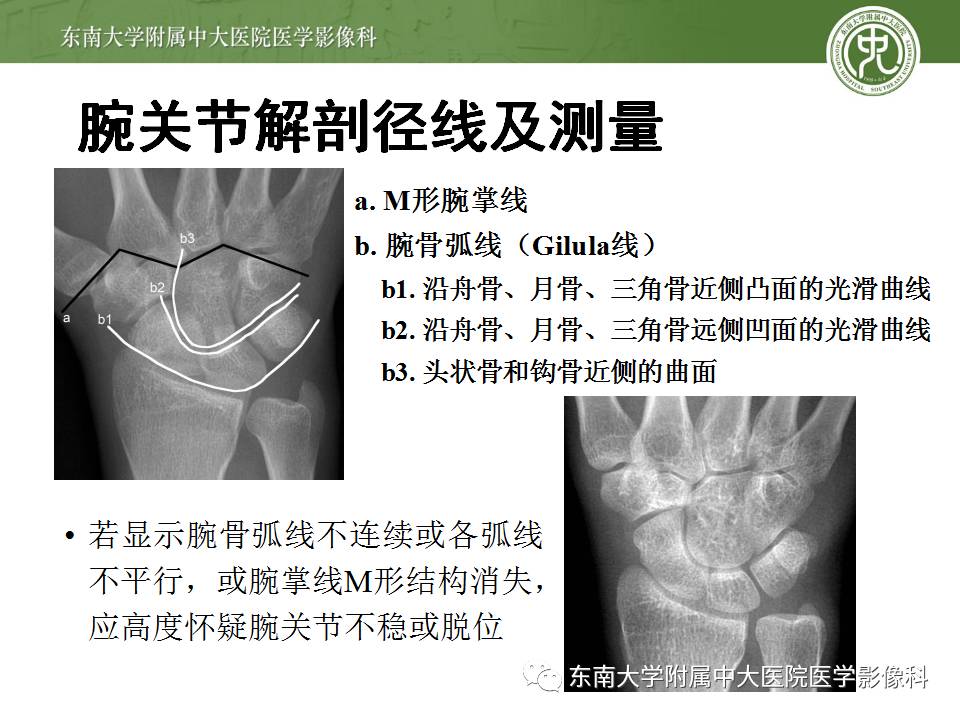 【病例】腕月骨无菌性坏死1例X线MR影像诊断