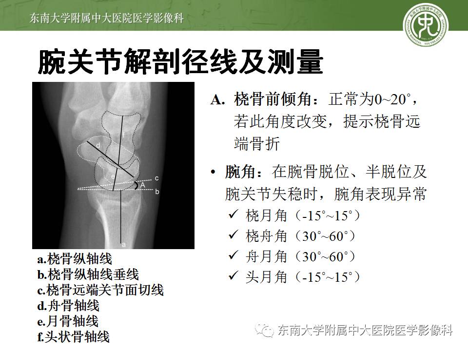 【病例】腕月骨无菌性坏死1例X线MR影像诊断