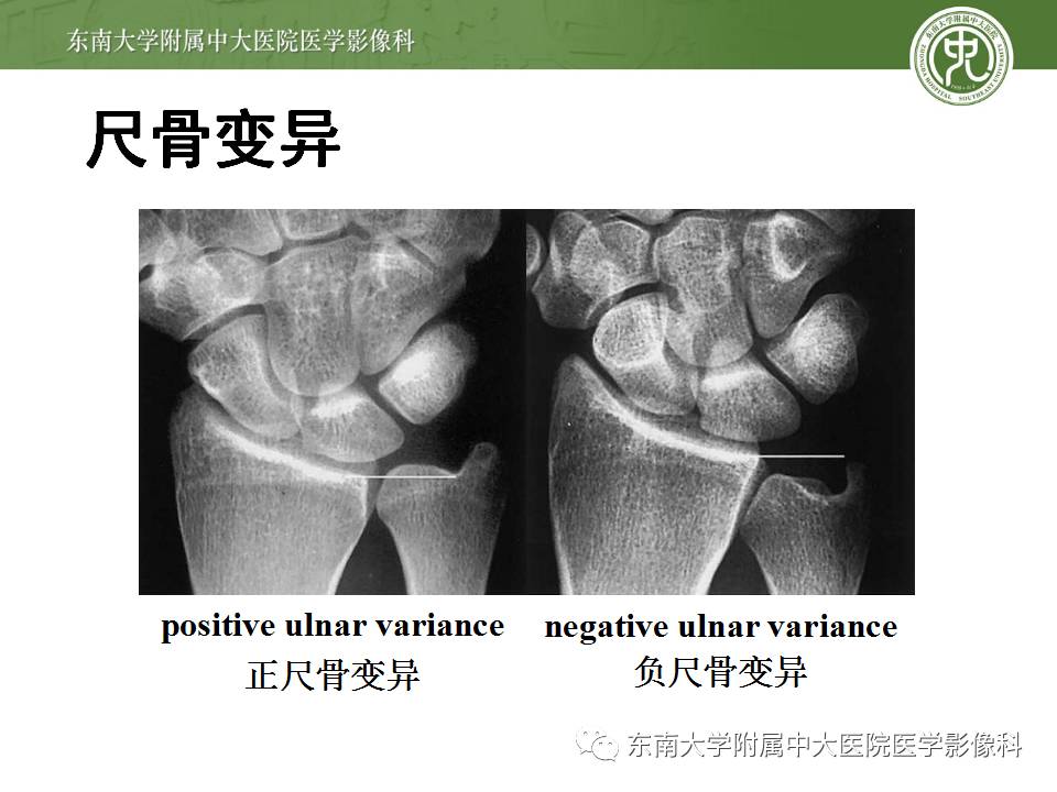 【病例】腕月骨无菌性坏死1例X线MR影像诊断