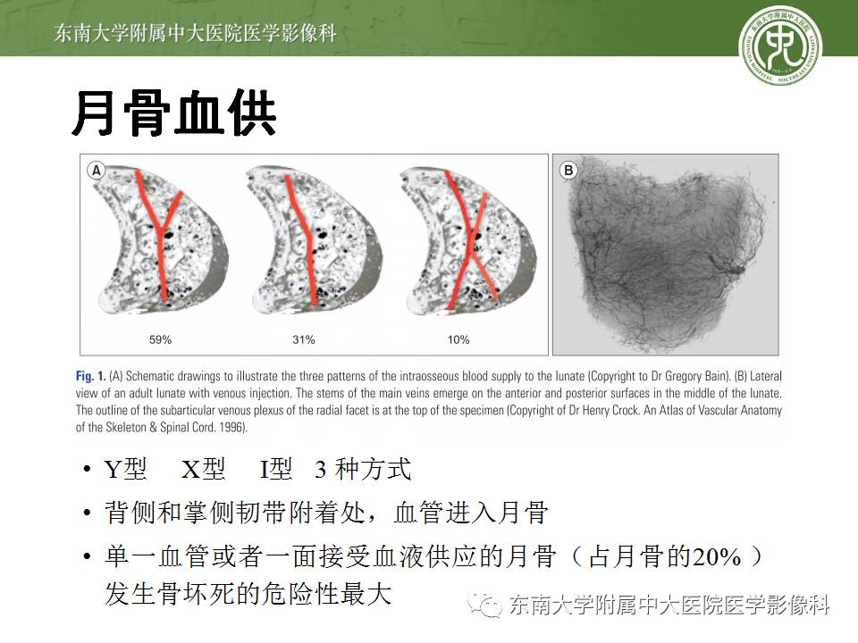 【病例】腕月骨无菌性坏死1例X线MR影像诊断
