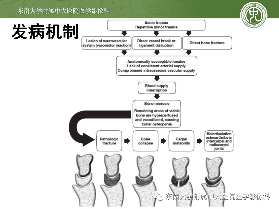 【病例】腕月骨无菌性坏死1例X线MR影像诊断