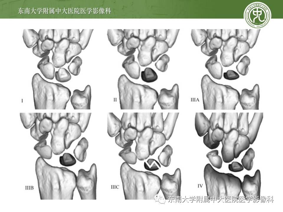 【病例】腕月骨无菌性坏死1例X线MR影像诊断
