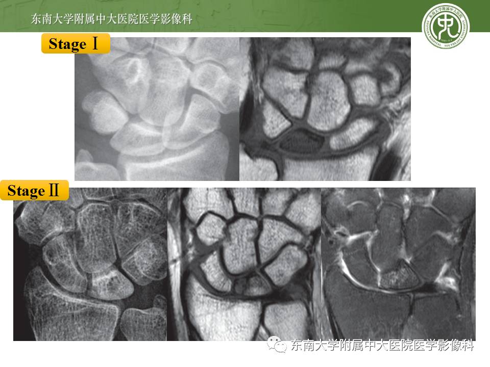 【病例】腕月骨无菌性坏死1例X线MR影像诊断