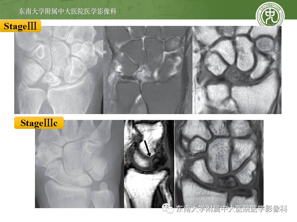 【病例】腕月骨无菌性坏死1例X线MR影像诊断