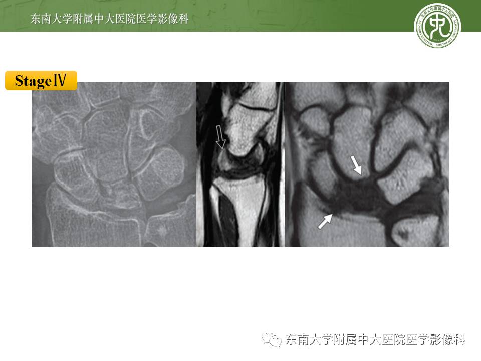 【病例】腕月骨无菌性坏死1例X线MR影像诊断