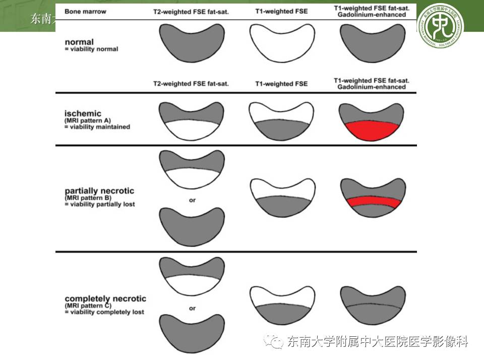 【病例】腕月骨无菌性坏死1例X线MR影像诊断