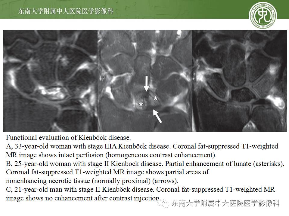 【病例】腕月骨无菌性坏死1例X线MR影像诊断