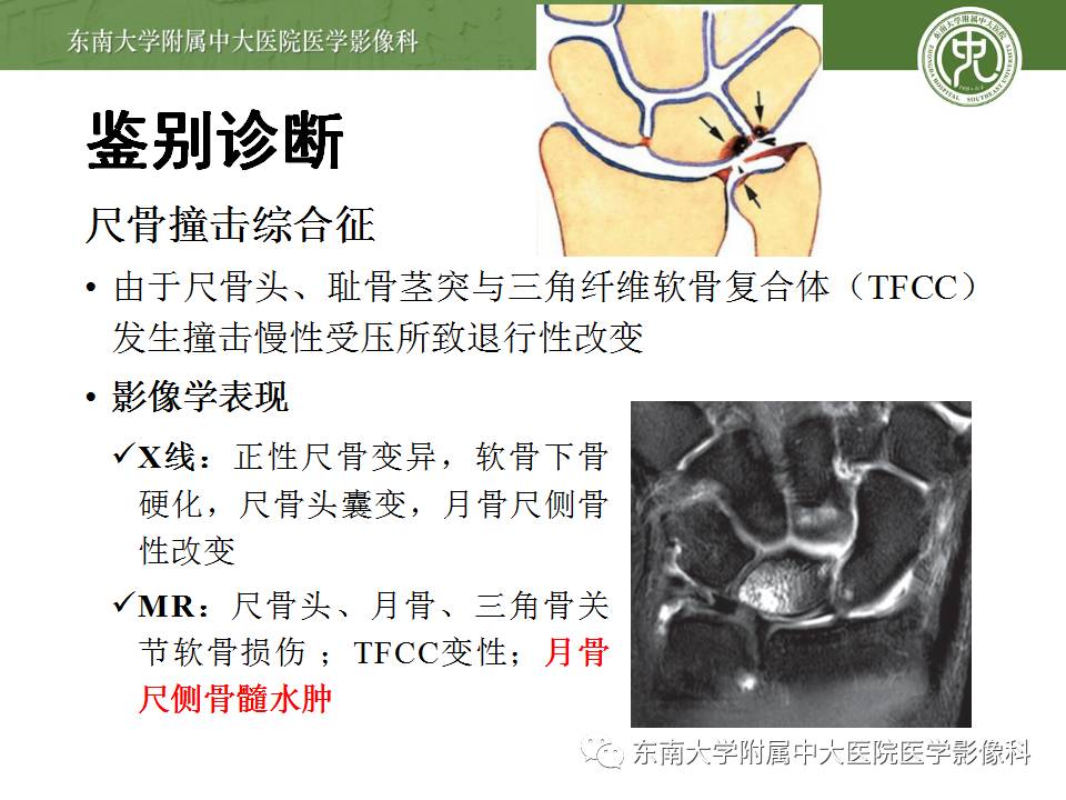 【病例】腕月骨无菌性坏死1例X线MR影像诊断