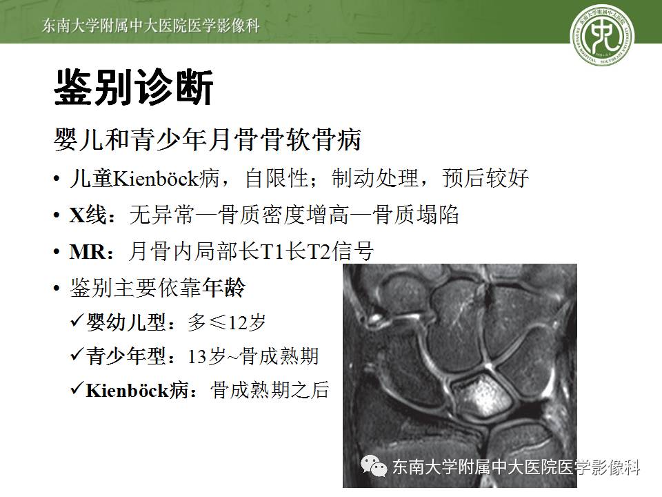 【病例】腕月骨无菌性坏死1例X线MR影像诊断