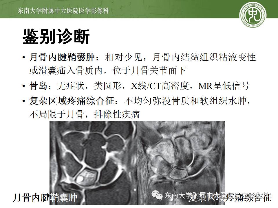 【病例】腕月骨无菌性坏死1例X线MR影像诊断