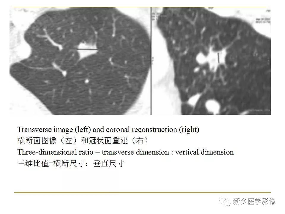 【PPT】孤立性肺结节：使用CT和PET/CT鉴别良恶性