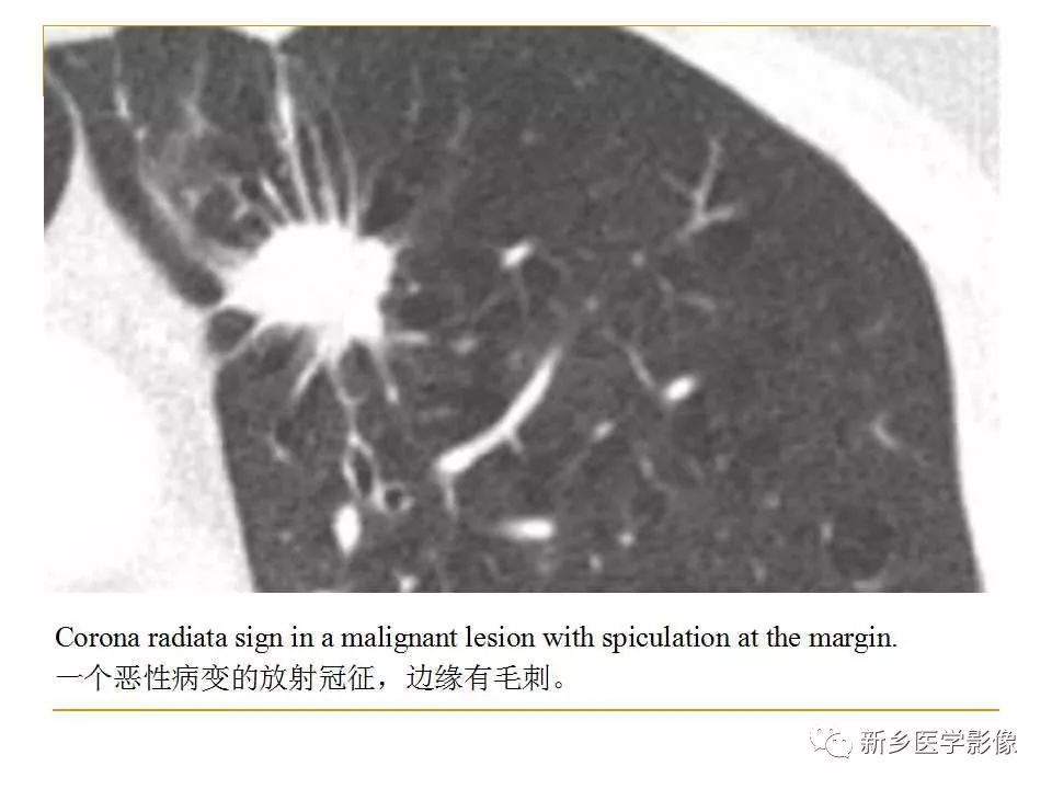 【PPT】孤立性肺结节：使用CT和PET/CT鉴别良恶性