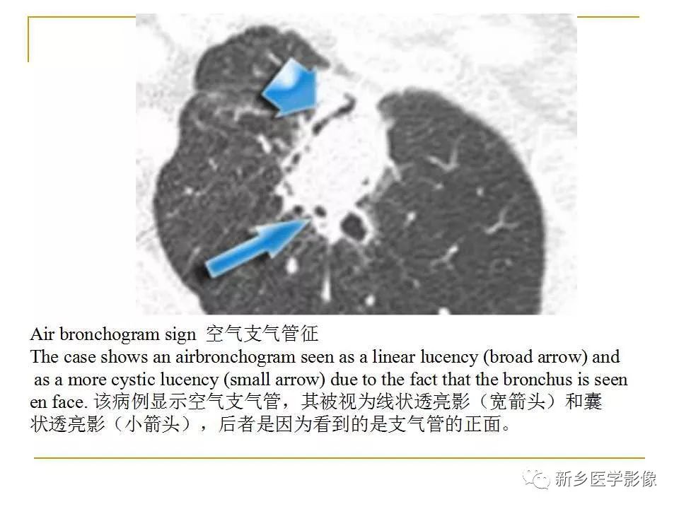 【PPT】孤立性肺结节：使用CT和PET/CT鉴别良恶性