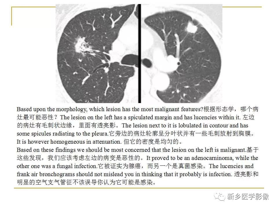 【PPT】孤立性肺结节：使用CT和PET/CT鉴别良恶性