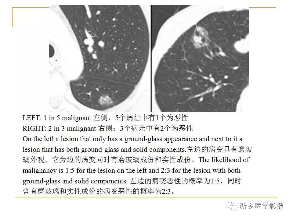 【PPT】孤立性肺结节：使用CT和PET/CT鉴别良恶性