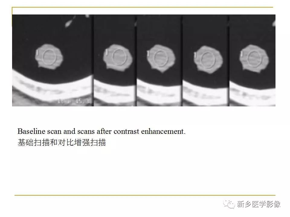 【PPT】孤立性肺结节：使用CT和PET/CT鉴别良恶性