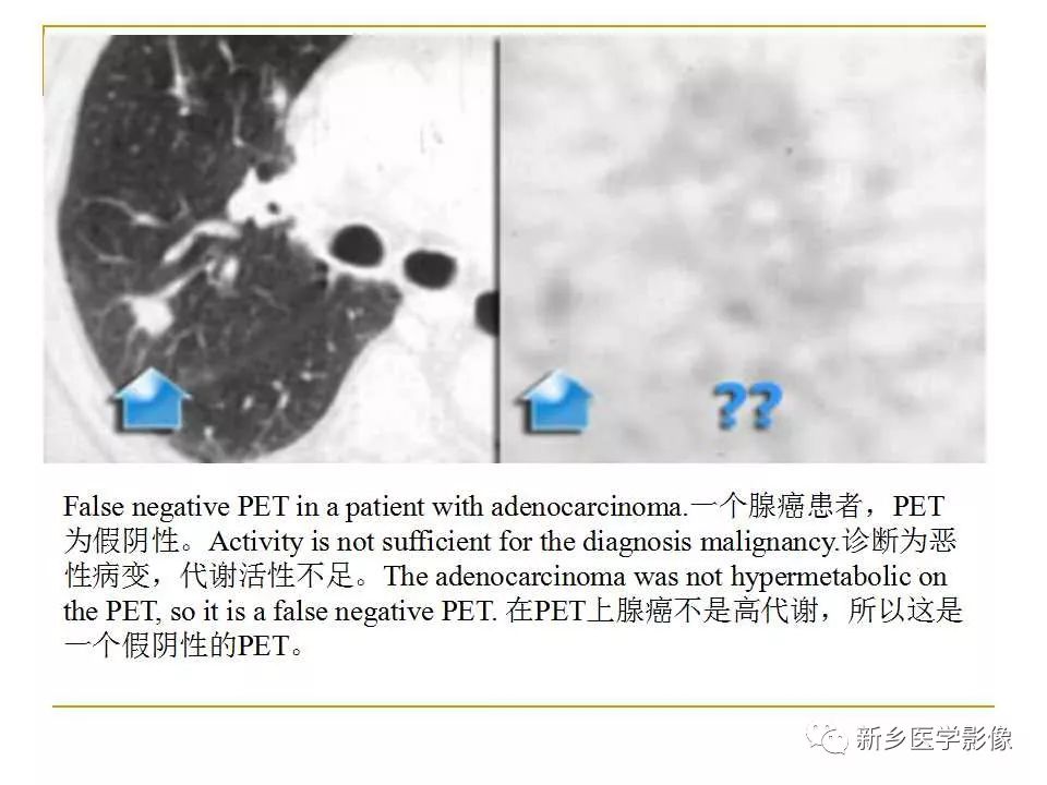 【PPT】孤立性肺结节：使用CT和PET/CT鉴别良恶性