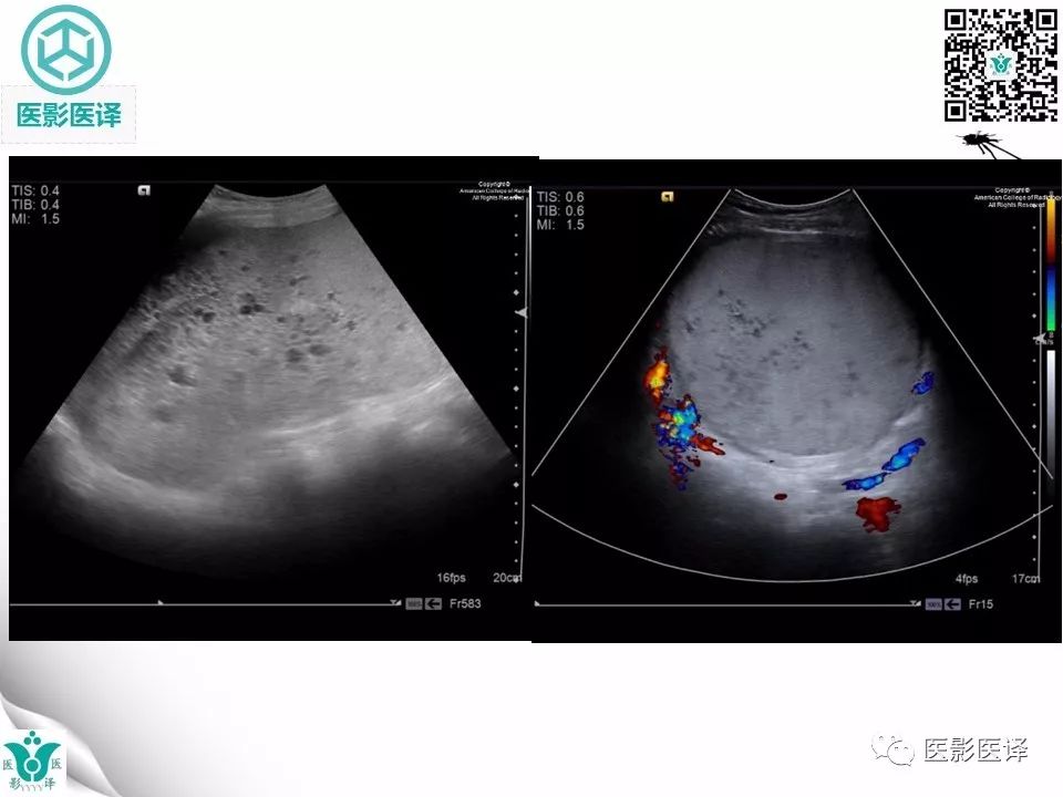 【病例】完全性葡萄胎1例MR影像表现
