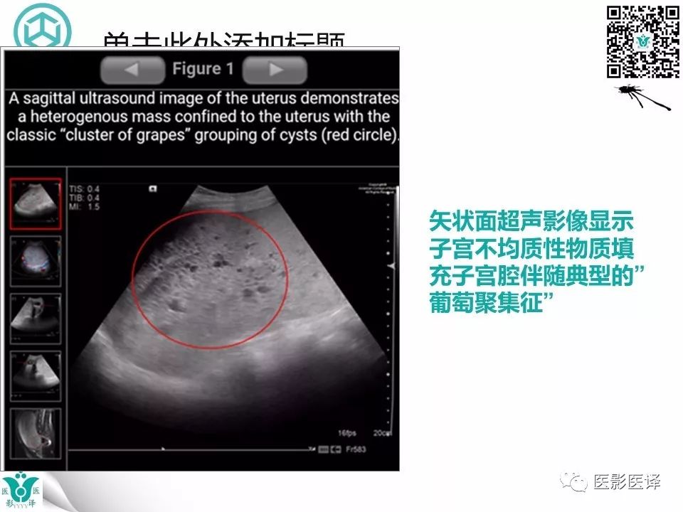【病例】完全性葡萄胎1例MR影像表现