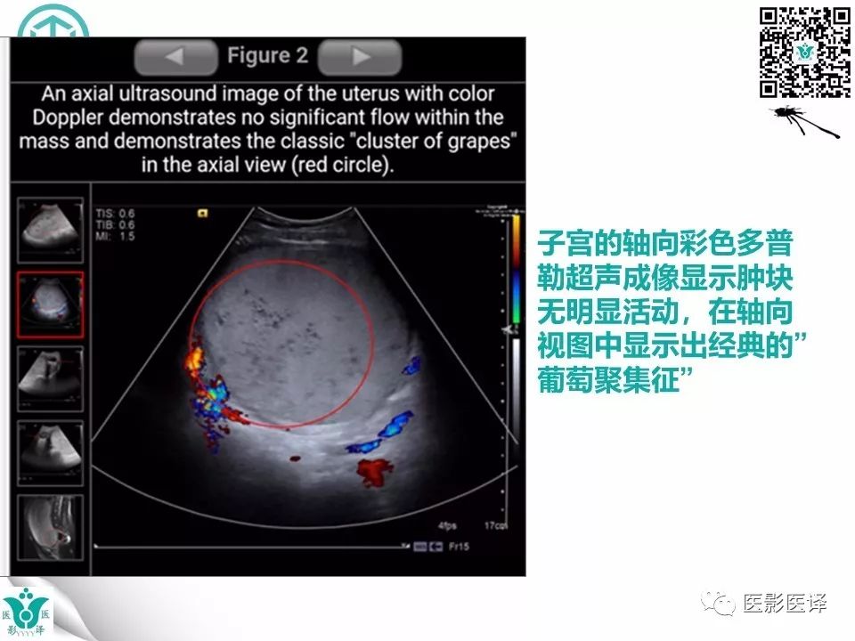 【病例】完全性葡萄胎1例MR影像表现
