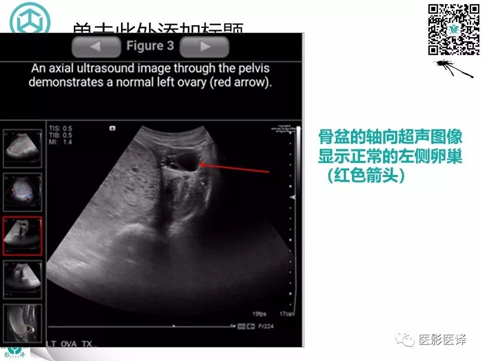 【病例】完全性葡萄胎1例MR影像表现
