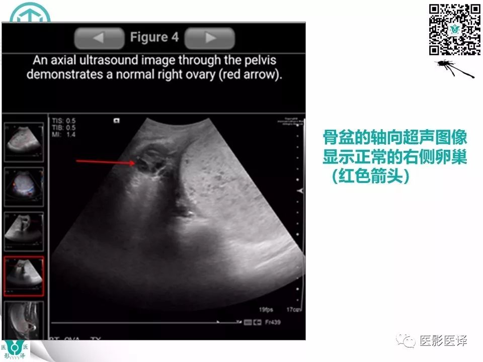 【病例】完全性葡萄胎1例MR影像表现