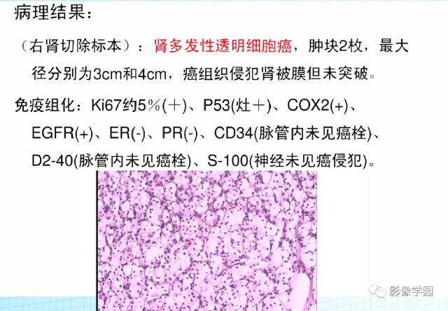 【病例】Von Hippel-Lindau综合征1例CT影像表现