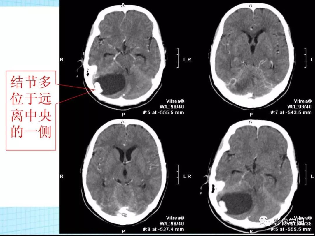 【病例】Von Hippel-Lindau综合征1例CT影像表现