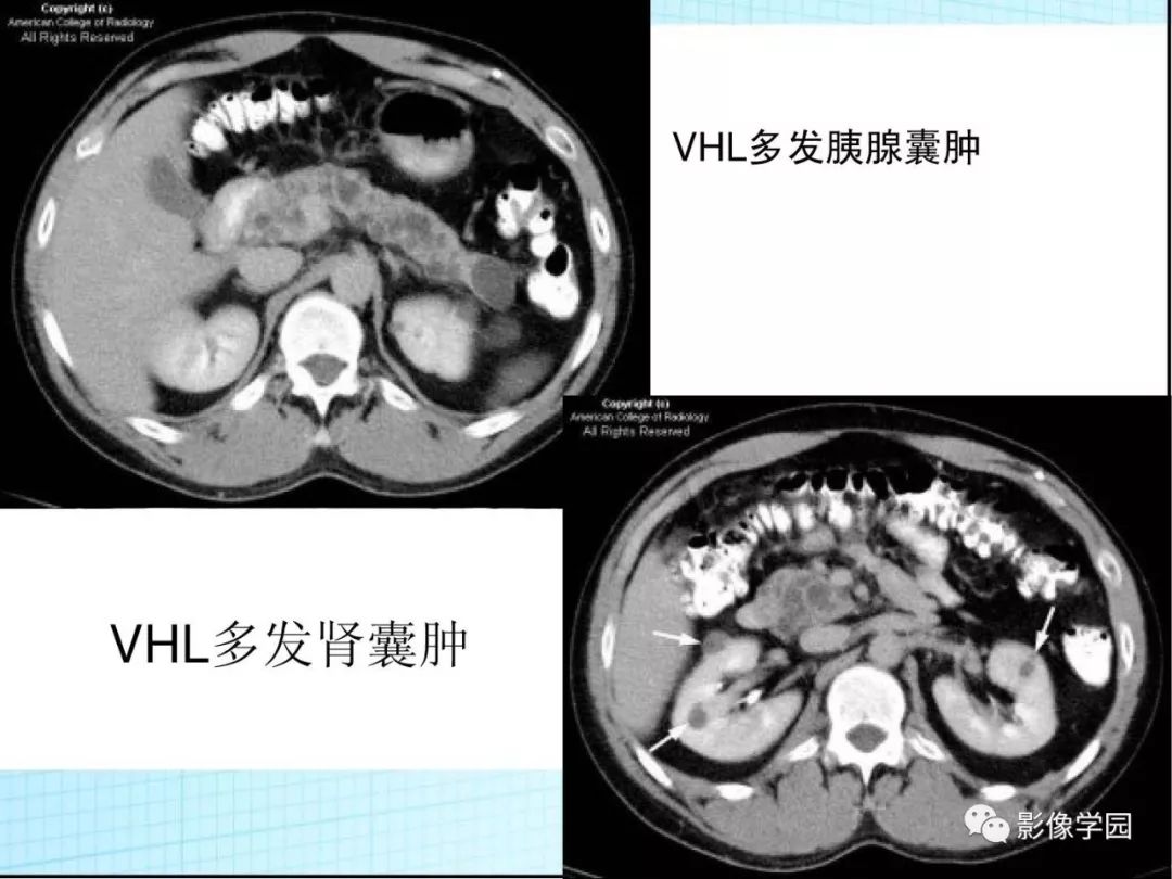 【病例】Von Hippel-Lindau综合征1例CT影像表现