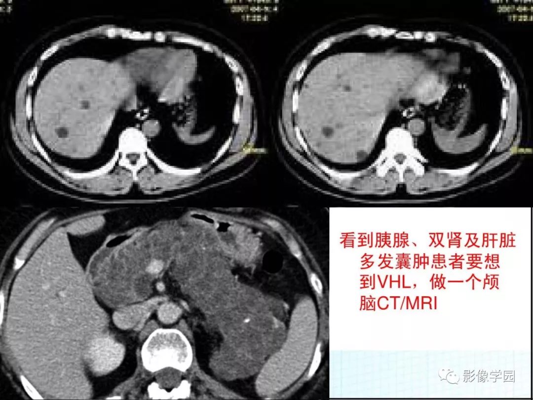 【病例】Von Hippel-Lindau综合征1例CT影像表现