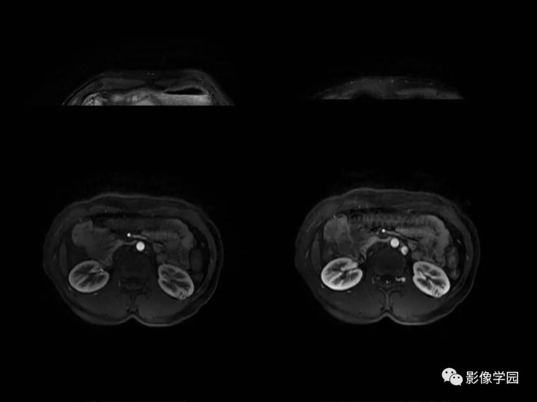 【病例】Von Hippel-Lindau综合征1例CT影像表现