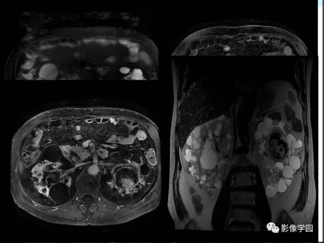 【病例】Von Hippel-Lindau综合征1例CT影像表现