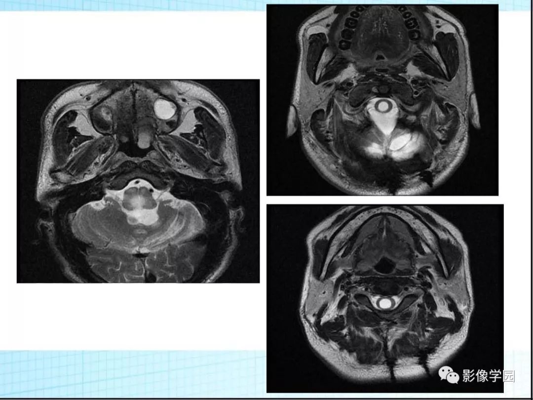 【病例】Von Hippel-Lindau综合征1例CT影像表现