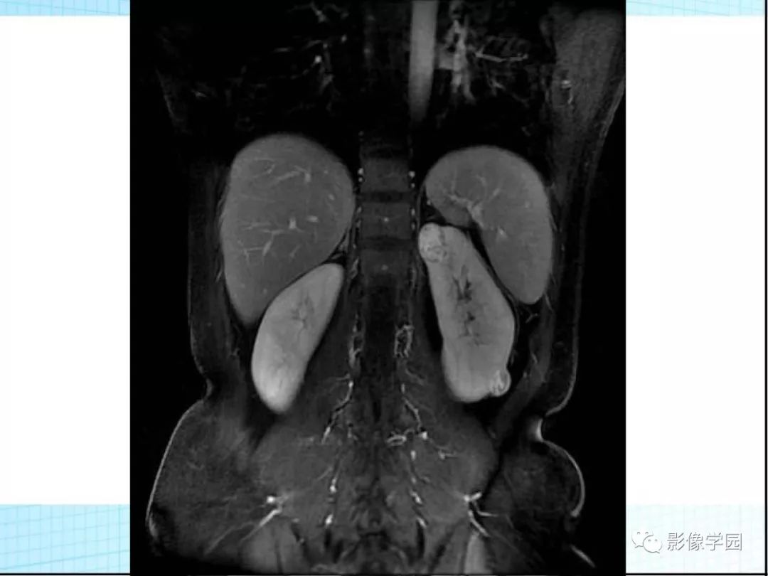 【病例】Von Hippel-Lindau综合征1例CT影像表现