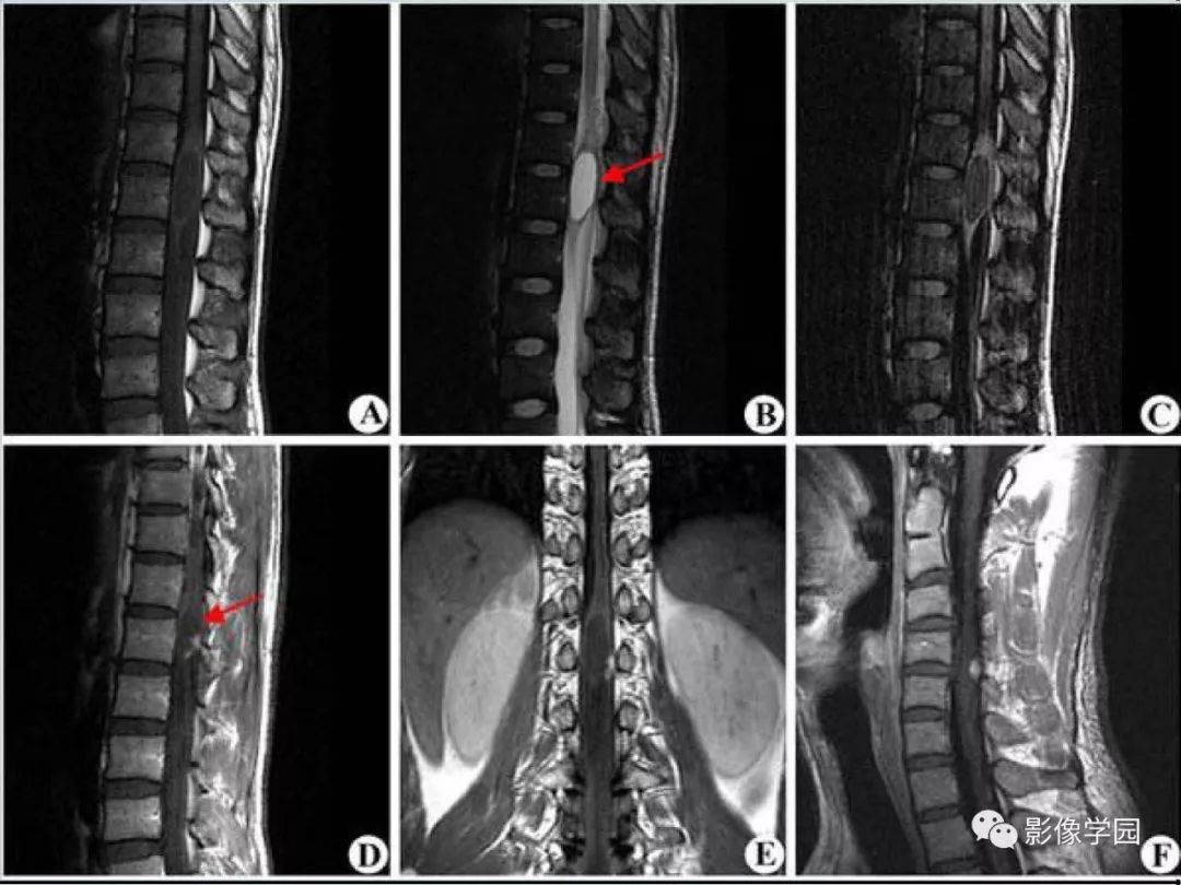 【病例】Von Hippel-Lindau综合征1例CT影像表现