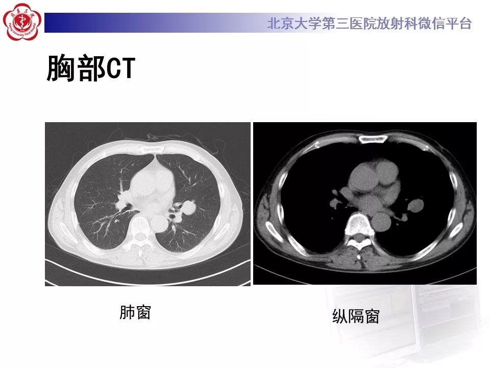 【病例】原发肺神经鞘瘤1例CT影像表现